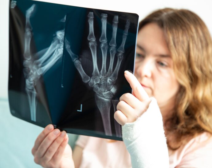 fracture