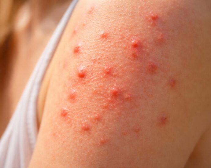 découvrez comment identifier les boutons causés par une allergie au soleil, leurs symptômes et les moyens de les prévenir efficacement.