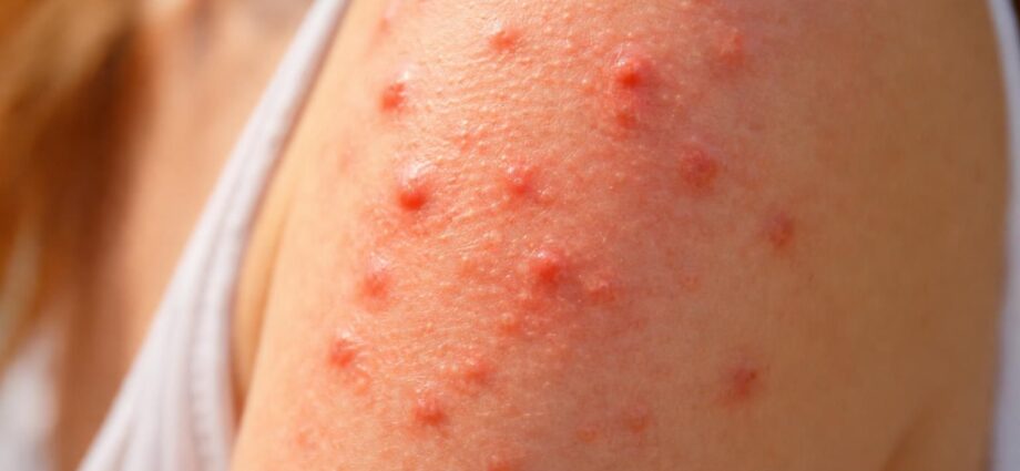 découvrez comment identifier les boutons causés par une allergie au soleil, leurs symptômes et les moyens de les prévenir efficacement.