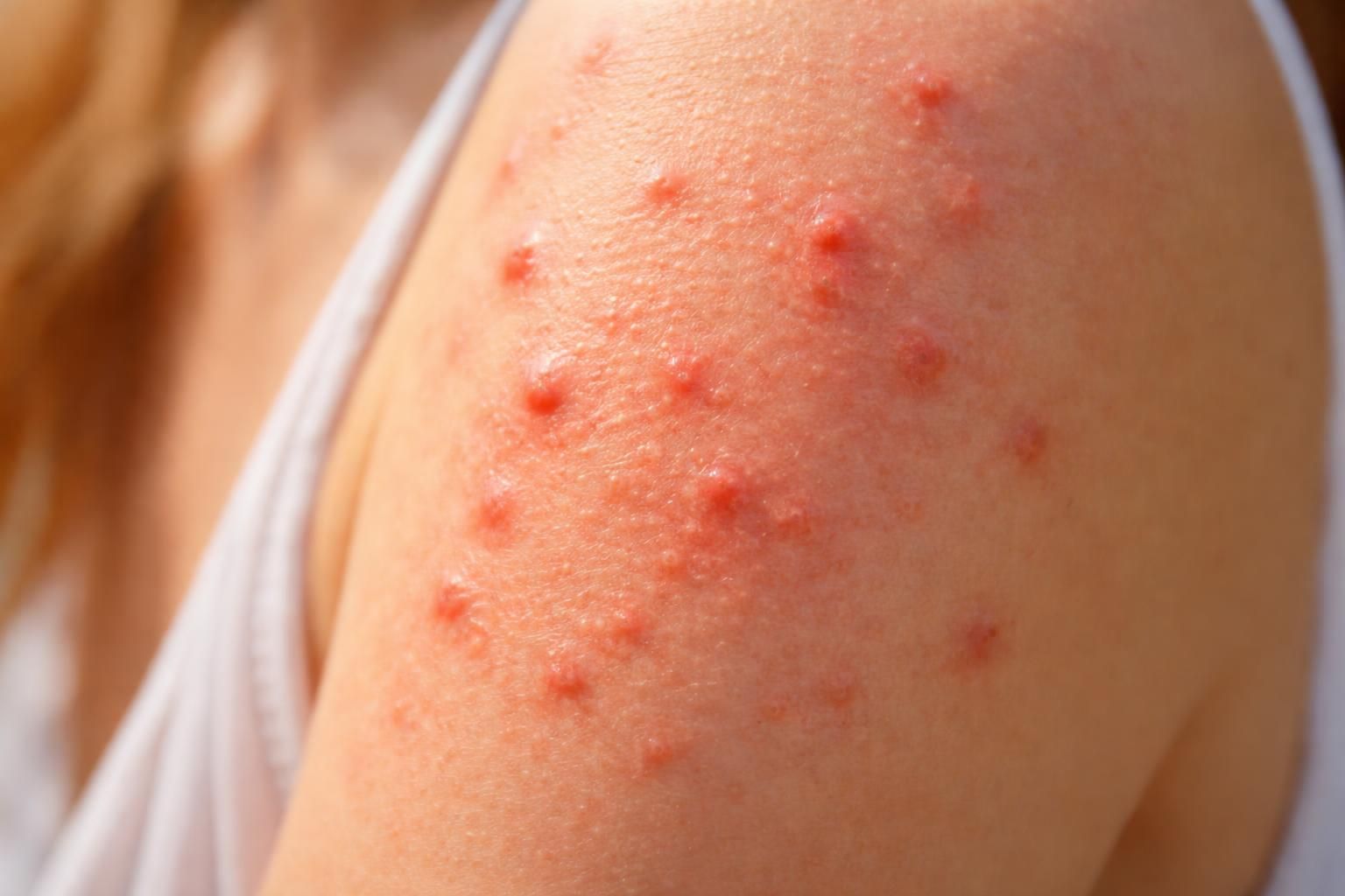 découvrez comment identifier les boutons causés par une allergie au soleil, leurs symptômes et les moyens de les prévenir efficacement.